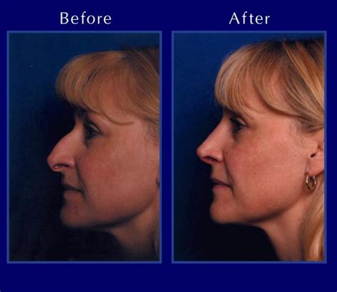 The Nose Clinic Before And After Nose Surgery Photos 8