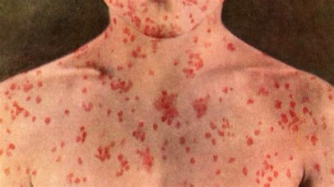 Measles Cases Reach Record High In Europe With Over 41000 People