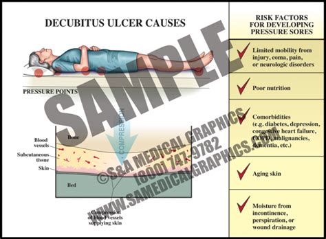 Decubitus Ulcer Causes S A Medical Graphics