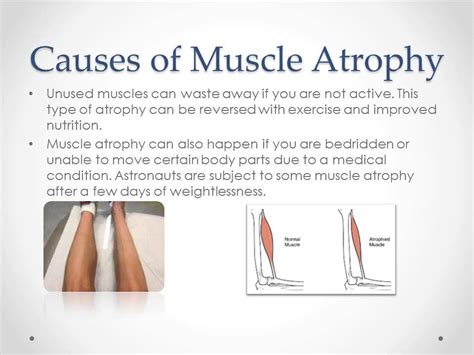 Muscle Atrophy Youtube