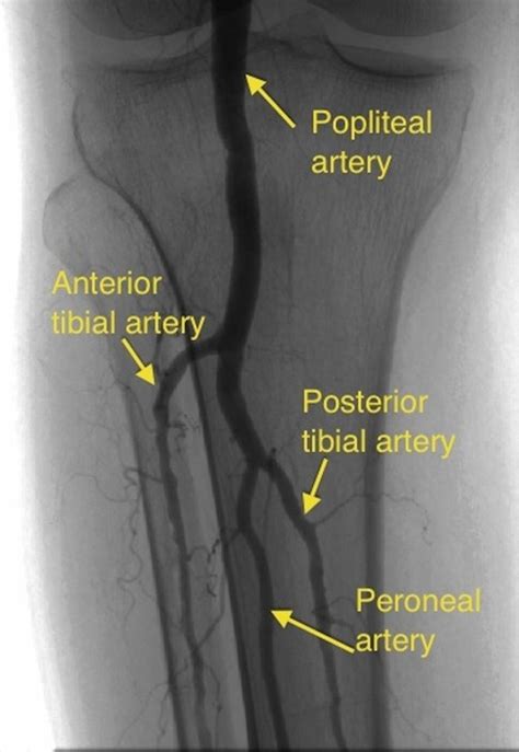 Popliteal Angiogram All About Cardiovascular System And Disorders