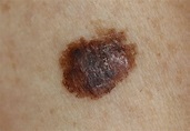 Skin Cancer: Signs, Symptoms, and Complications