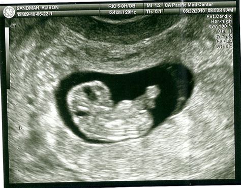 Eight Weeks Pregnant Ultrasound The Image Kid Has It