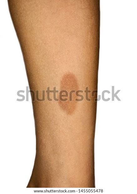 Birthmark On Leg Southeast Asian Child Stock Photo 1455055478