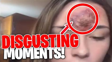 Disgusting Pimple Popping Moments Part Youtube