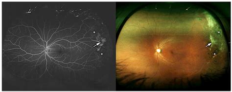 Ultra Widefield Fluorescein Angiography Left And Widefield Fundus