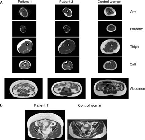 Body Fat Distribution Of Patients Magnetic Resonance Imagery Mri
