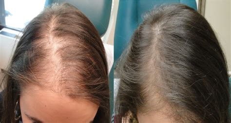 Hair Loss Pictures Before After