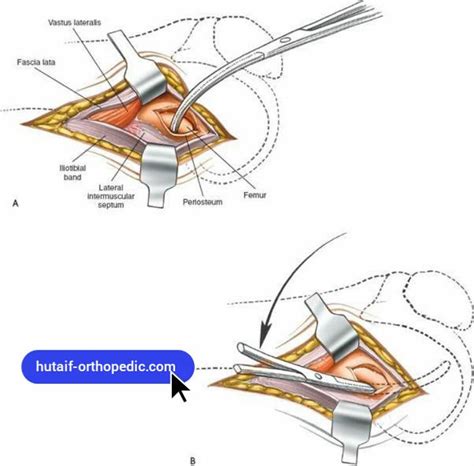 Lateral Approach To The Distal Femur For Anterior Cruciate Ligament Surgery