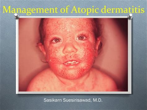 Management Of Atopic Dermatitis Risk Factors Treatments And