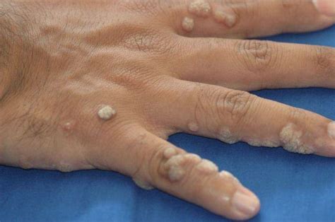 Everything You Need To Know About Warts Med Warts