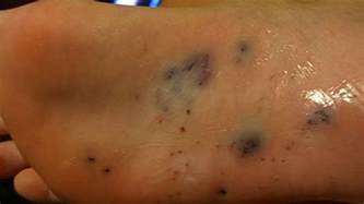 Sea Urchin Sting Treatment Removal And Long Term Effects