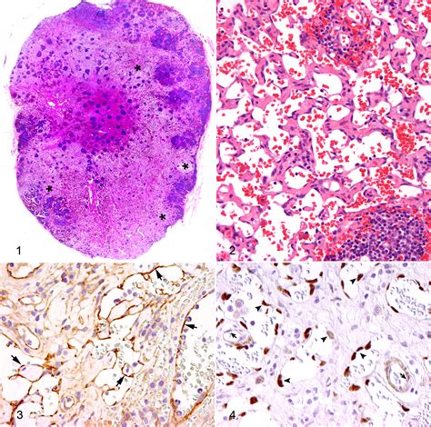 Plexiform Vasculopathy In Feline Cervical Lymph Nodes Nicole