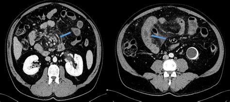 Right Paraduodenal Hernia Accompanying Superior Mesenteric Vein