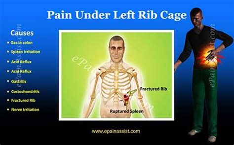 Slipping rib syndrome occurs when the cartilage on a person's lower ribs slips and moves, leading to pain in their chest or upper abdomen. Pin on Interesting