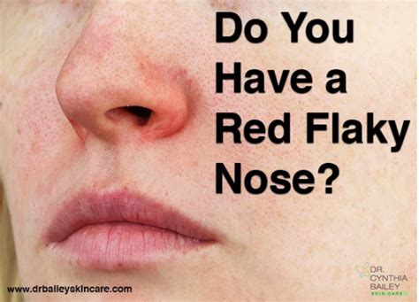 Do You Have A Red Flaky Nose Dry Nose Skin Flaking Skin Flakey Skin