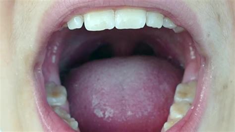 A Child S Tonsils Mouth Footage Videos And Clips In Hd And 4k