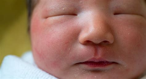 What Causes Milia In Newborns Babycenter