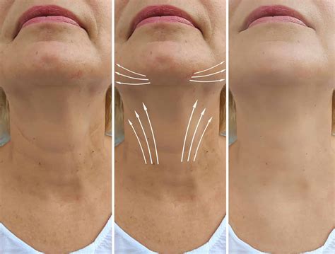 Sagging Neck Best Treatment To Treat It Dr Anthony Bared Miami