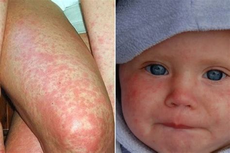 Huge Rise In Measles And Scarlet Fever Cases In Essex In 2018 Public