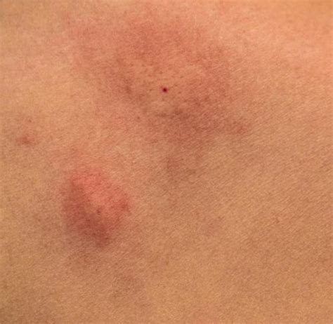 Hepatitis Skin Rash Pictures