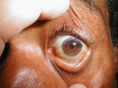 Causes Of Brown Spots On The Olimens Eyecare Centre