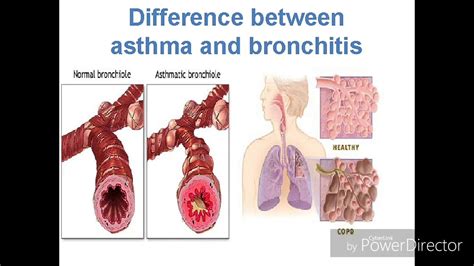 Difference Between Asthma And Bronchitishd Youtube
