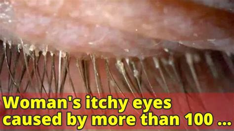 Womans Itchy Eyes Caused By More Than 100 Parasites In Eyelashes Report Youtube