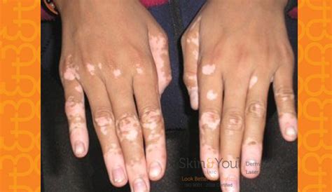 Vitiligo White Patches