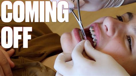 The Braces Are Coming Off Full Braces In Less Than One Year How To Shorten Time With Braces