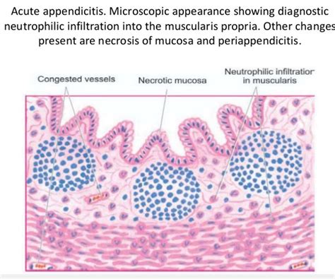 Pathology Of Acute Appendicitis Its Etiology Morphology Gross
