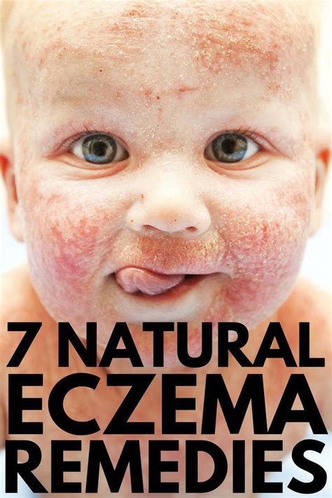 If Youre On The Hunt For Eczema Remedies That Work Quickly And