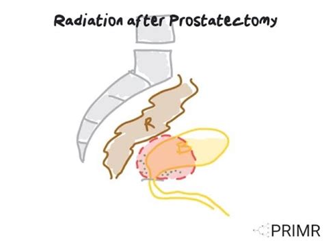 Doctor Explains Radiation After Prostatectomy Youtube