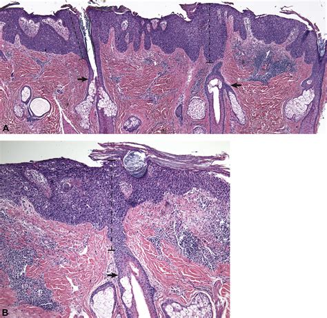 Histopathologic Assessment Of Depth Of Follicular Invasion Of Squamous