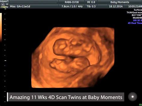 Amazing Twins 4d Scan At Baby Moments Call 08000075076 Youtube