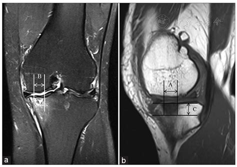 Clinical Characteristics And Treatment Of Spontaneous Osteonecrosis Of