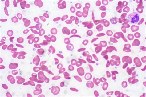 Sickle Cell Anemia Mutation Sickle Cell Disease Ask Hematologist