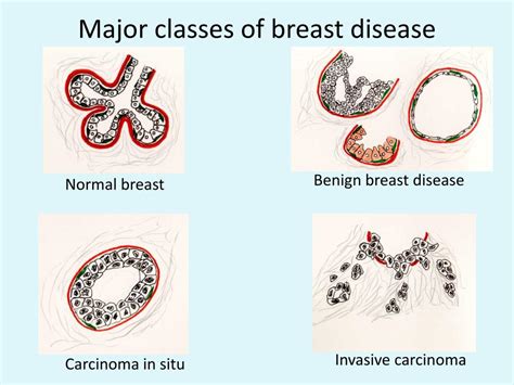 Ppt Breast Pathology Powerpoint Presentation Free Download Id486107