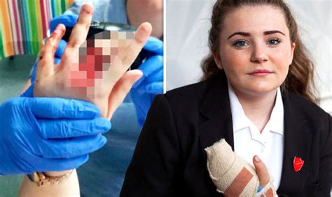 14 Year Ol Schoolgirl Has Her Finger Amputated After Prank Went Wrong