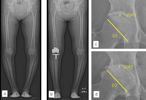 Measurements Of The Hip Joint Space Width In A Representative Case A