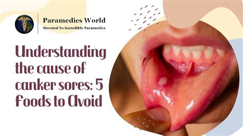 Understanding The Cause Of Canker Sores 5 Foods To Avoid