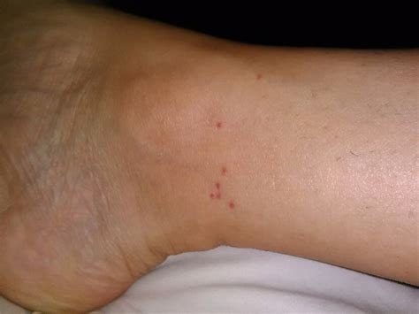 Tiny Red Dots Around My Anklepic Not Nasty Babycenter