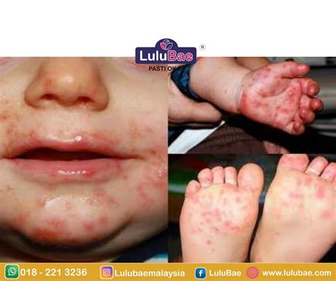 Hfmd Hand Foot And Mouth Disease Lulubae