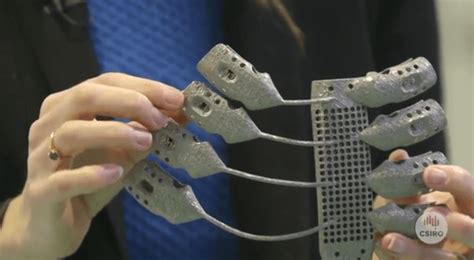 Patient Receives A 3d Printed Rib Cage Implant In Rare Surgery