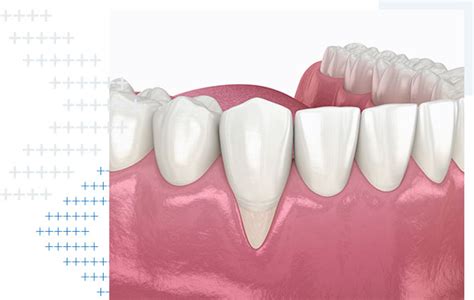 Gum Recession Sydney Periodontics And Dental Implant Centre