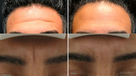 Best Treatment For Frown Lines Near Me New Jersey Forehead Wrinkles