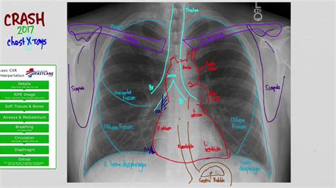 Each of these anatomical structures should be viewed using a systematic approach. 01 CXR Anatomy - YouTube