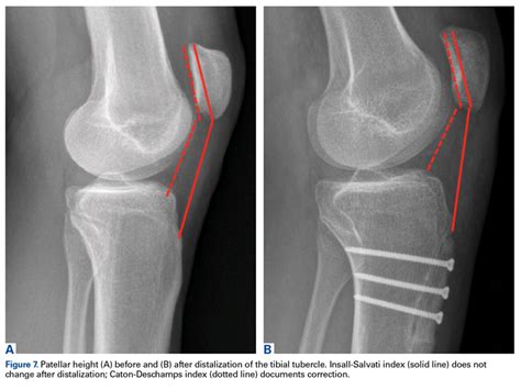 Patella Alta A Comprehensive Review Of Current Knowledge Mdedge Surgery
