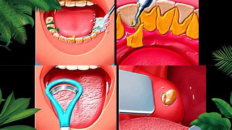 Asmr Get Rid Of Bad Breath Tonsil Stone Removal Salivary Glands