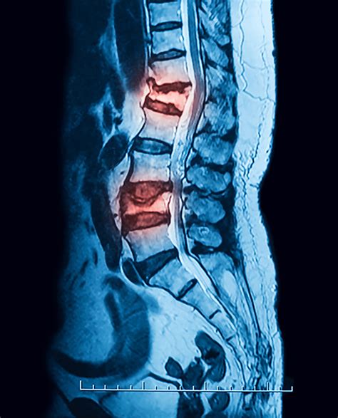 Vertebral Compression Fracture Treatment In Nj And Nyc Premier Brain And Spine
